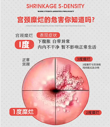 严重宫颈糜烂有什么症状