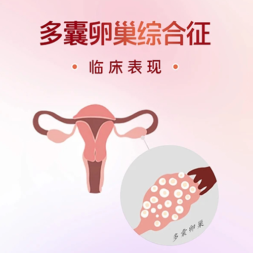 女性多囊卵巢怎么治疗最好