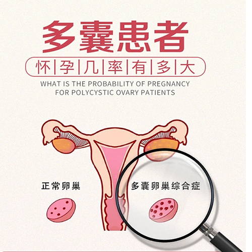 女性多囊卵巢可以怀孕吗
