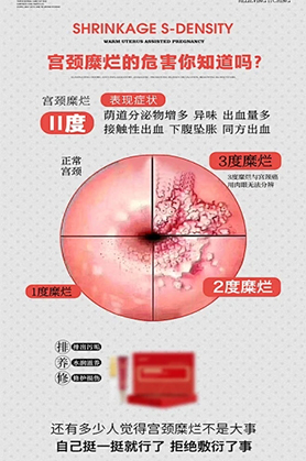 重度宫颈糜烂怎么治疗才能彻底好