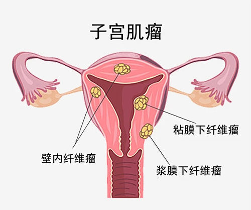 子宫肌瘤是什么造成的，该怎样治疗