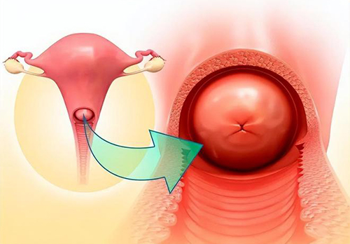 宫颈肥大是怎么回事需要治疗吗